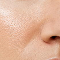 Pores dilatés